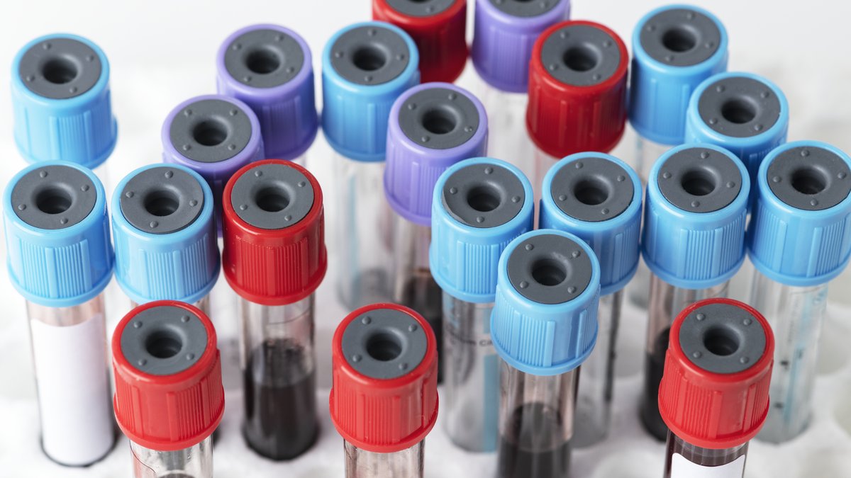 Blood sample tubes with coloured caps standing in a pathology lab rack