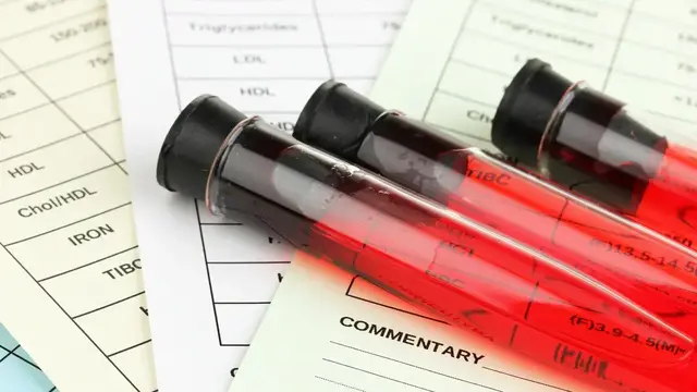Three tubes of blood lying on printed pathology result sheets