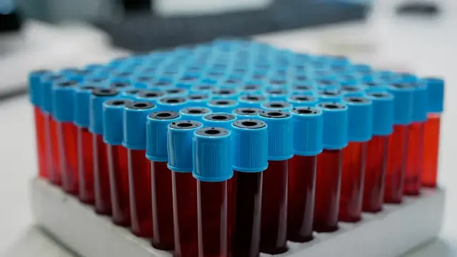 A tray of blue capped blood collection tubes filled with blood on a laboratory bench